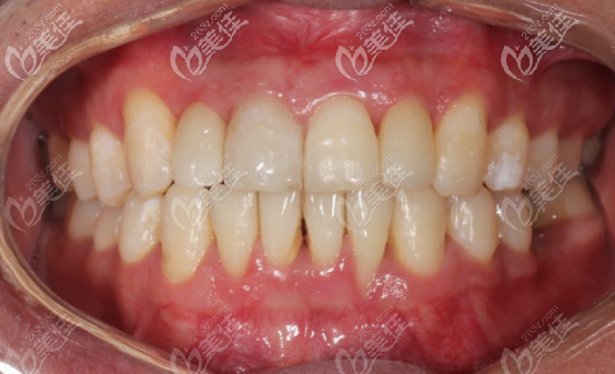 隱適美矯正安氏一類錯頜畸形的真人案例（來自揭陽牙博士）