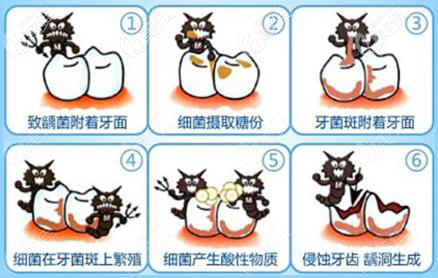 兒童齲齒的形成過程 兒童齲齒的形成過程