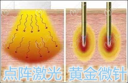 黃金微針和點(diǎn)陣哪個(gè)好 黃金微針和點(diǎn)陣哪個(gè)好