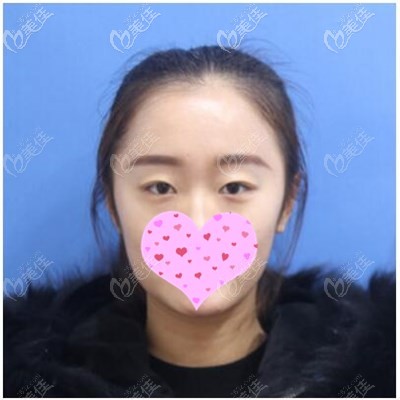 雙眼皮手術(shù)前 雙眼皮手術(shù)前