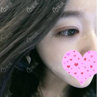 找王莉莉做雙眼皮術(shù)后 找王莉莉做雙眼皮術(shù)后