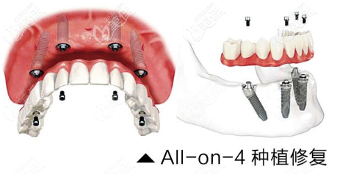 All-on-4即刻種植圖示 All-on-4即刻種植圖示