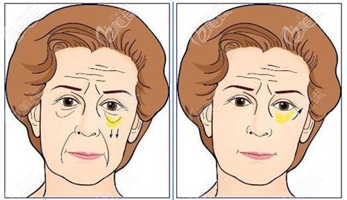 下拉皮手術(shù)能去淚溝和法令紋嗎 下拉皮手術(shù)能去淚溝和法令紋嗎