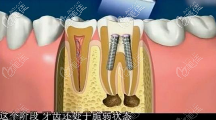 牙齒根管治療圖示 牙齒根管治療圖示