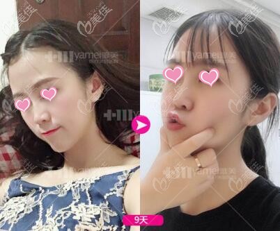 注射玻尿酸隆鼻術(shù)后9天照