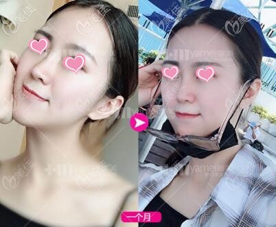 玻尿酸隆鼻術(shù)后1個(gè)月效果照