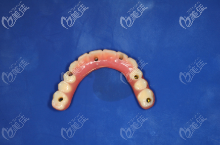 All-on-6種植體 All-on-6種植體