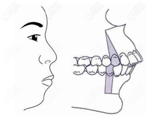 齙牙矯正 齙牙矯正