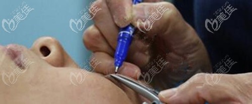 郭偉院長做雙眼皮的優(yōu)勢 郭偉院長做雙眼皮的優(yōu)勢