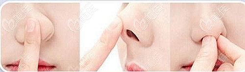 閏文超主任做耳軟骨隆鼻的技術(shù)優(yōu)勢