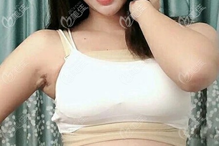 做完傲諾拉假體隆胸術(shù)后第十天照片 做完傲諾拉假體隆胸術(shù)后第十天照片