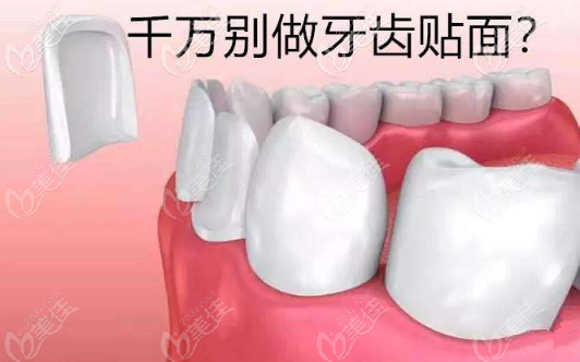 牙齒貼面好不好