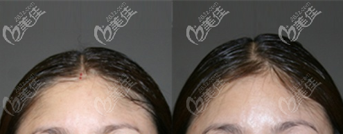 韓國(guó)顱頂增高手術(shù)案例:骨水泥填充頭頂增高1cm