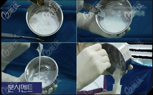 顱頂增高手術(shù)（骨水泥墊頭頂）手術(shù)過(guò)程圖