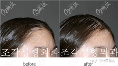 韓國(guó)雕刻整形外科醫(yī)院宋龍?zhí)┕撬嗵畛漕^頂案例效果