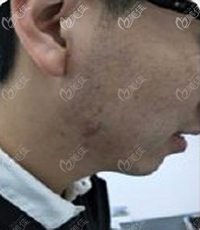 下頦痘痘增生性瘢痕 下頦痘痘增生性瘢痕