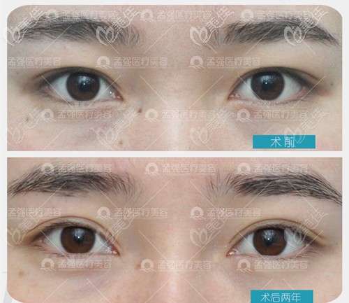 雙眼皮失敗修復(fù)案例