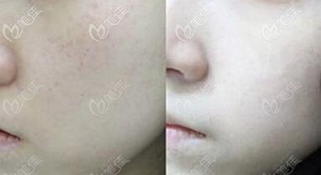 皮秒激光祛斑后的效果 皮秒激光祛斑后的效果