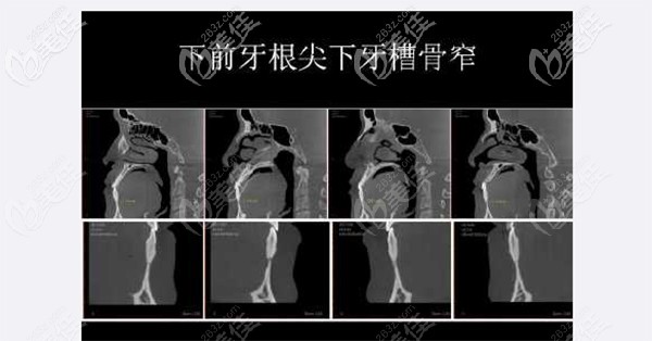 孩子下前牙根尖下牙槽骨窄
