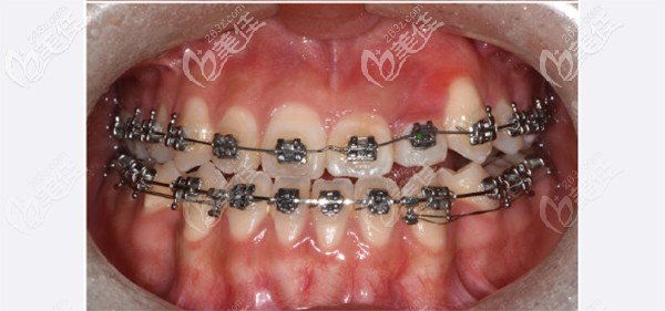 戴上牙套后娃的牙齒