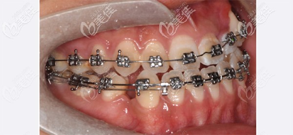 寶媽分享貼：兒童牙齒對(duì)刃是怎么矯正比較好？
