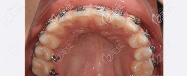 半年后牙齒對(duì)刃金屬牙套矯正