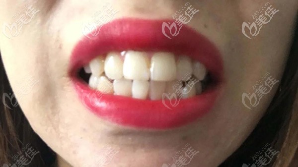 牙齒還算整齊，但嘴巴很突