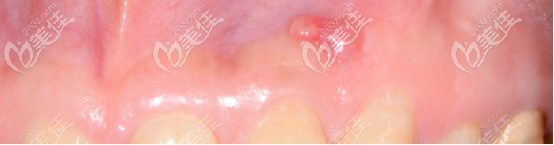 膿包的具體位置 膿包的具體位置