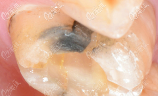 故事從我根管治療后牙齦處長了一個小膿包說起（有配圖）