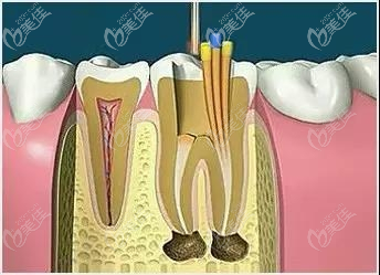 根管填充示意圖 根管填充示意圖