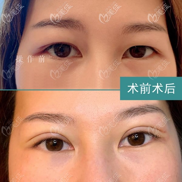 猜猜我在南充艾迪做的切開法雙眼皮花了多少錢?這是術(shù)后7天恢復(fù)圖