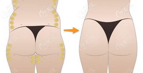 自體脂肪豐臀 自體脂肪豐臀