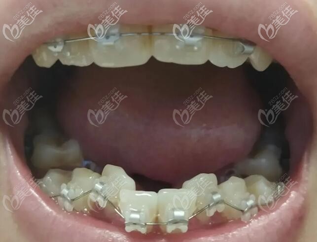 下排牙齒擁擠初戴陶瓷牙套的照片 下排牙齒擁擠初戴陶瓷牙套的照片