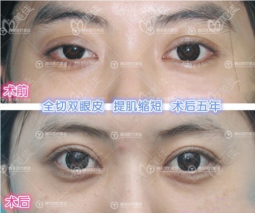 孟強(qiáng)雙眼皮修復(fù)案例
