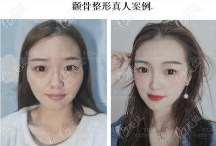 重慶時光顴弓內(nèi)推<span style=