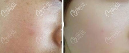 超皮秒祛雀斑效果對比圖 超皮秒祛雀斑效果對比圖