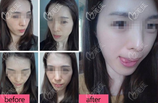 北京南加DGS四維青春復原術案例