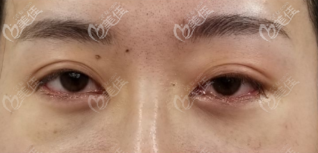 術(shù)后即刻圖片