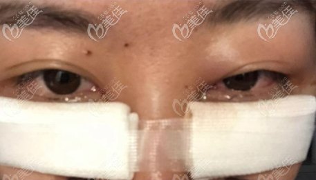 重慶美萊內(nèi)切祛眼袋術(shù)后2天圖片
