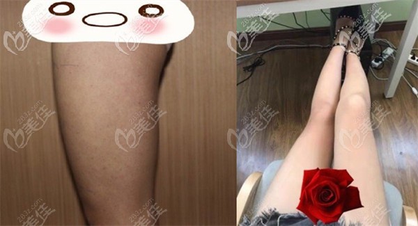 去貴陽美萊做吸脂瘦大腿效果