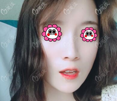 艾莉薇玻尿酸隆鼻術(shù)后5天恢復(fù)照