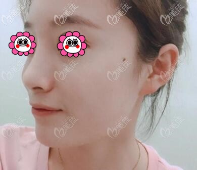 沒想到在沈陽名流注射艾莉薇玻尿酸隆鼻后的效果比我預想的要好！