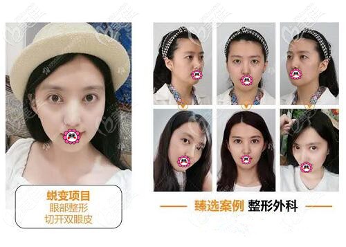 沈陽百嘉麗劉醫(yī)割雙眼皮真人案例圖 沈陽百嘉麗劉醫(yī)割雙眼皮真人案例圖