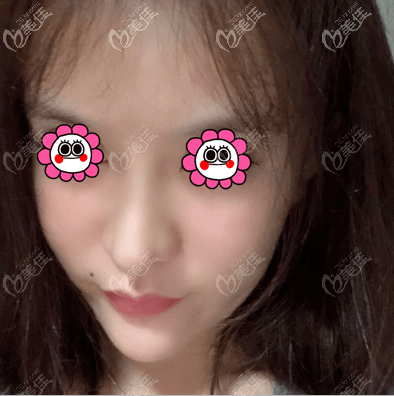 在北京蒂凡妮醫(yī)療美容做全臉脂肪填充有8天了 在北京蒂凡妮醫(yī)療美容做全臉脂肪填充有8天了