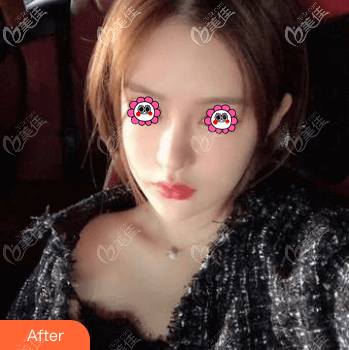 我在北京蒂凡妮醫(yī)療美容做的全臉脂肪填充效果還是挺中意的