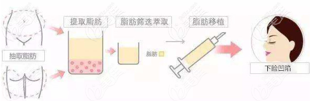 下眼瞼凹陷脂肪填充手術(shù)示意圖 下眼瞼凹陷脂肪填充手術(shù)示意圖