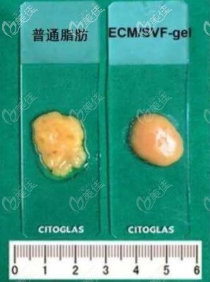 普通脂肪與脂肪膠的區(qū)別 普通脂肪與脂肪膠的區(qū)別