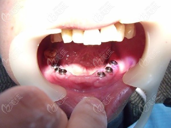 70歲老人下半口牙齒缺失<span style= 70歲老人下半口牙齒缺失<span style=