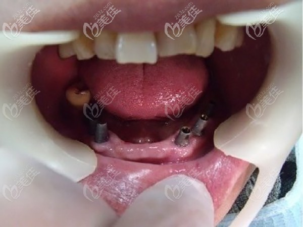 allon6吧半口種植體 allon6吧半口種植體