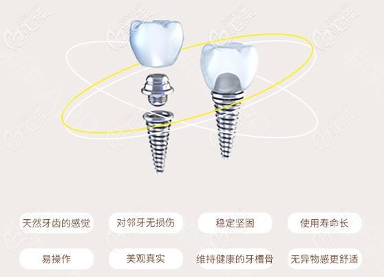 韓國登騰種植牙優(yōu)勢